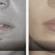 before and after dermal fillers gallery
