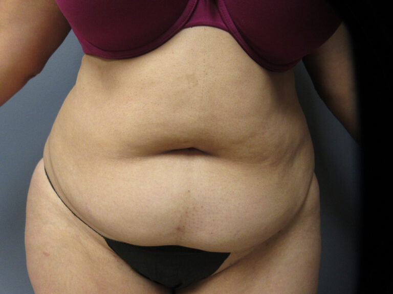 56 year old female tummy tuck front view before
