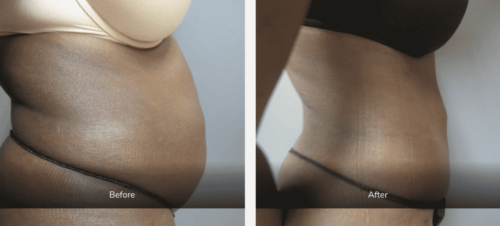 body contouring surgery before and after mommy makeover gallery