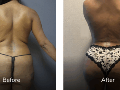 40 Year 142 lbs 5'4 before and after Vaser Liposuction