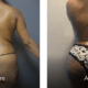 40 Year 142 lbs 5'4 before and after Vaser Liposuction