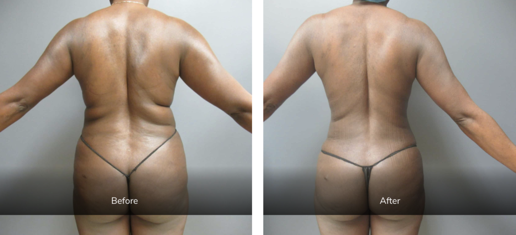 before and after body contouring