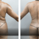 before and after body contouring