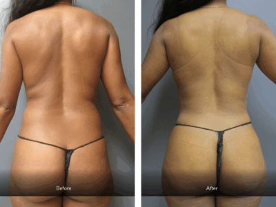 before and after liposuction