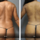 before and after liposuction