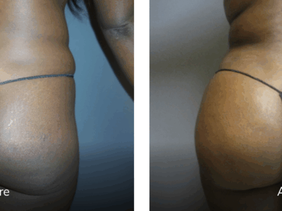 36 year old female before and after BBL featured image