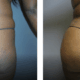 36 year old female before and after BBL featured image