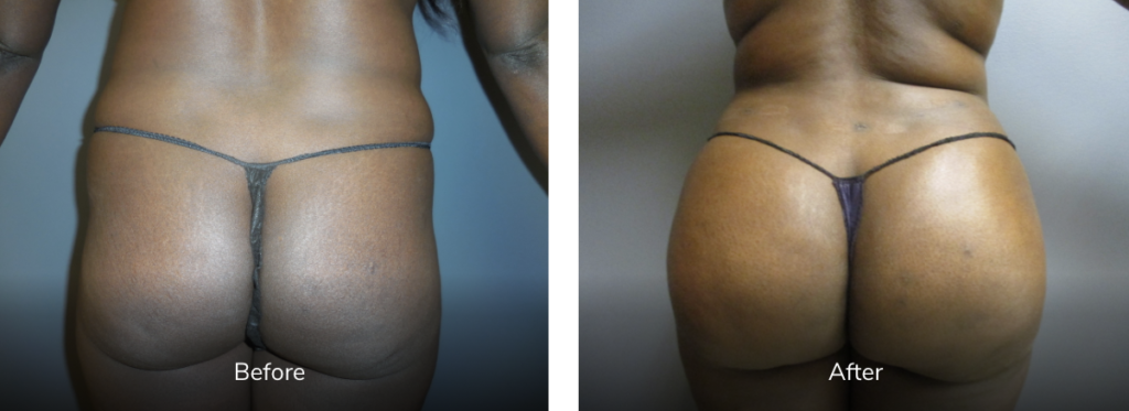 body contouring surgery before and after bbl