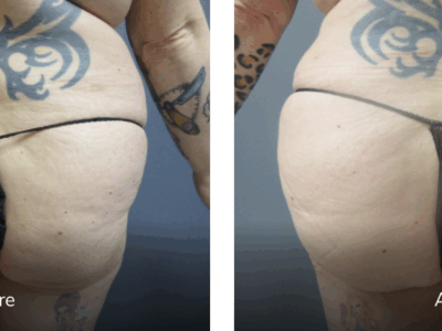 43 yr old female 5'2 180 lbs before and 8 weeks After BBL (fat transfer to buttocks) featured image