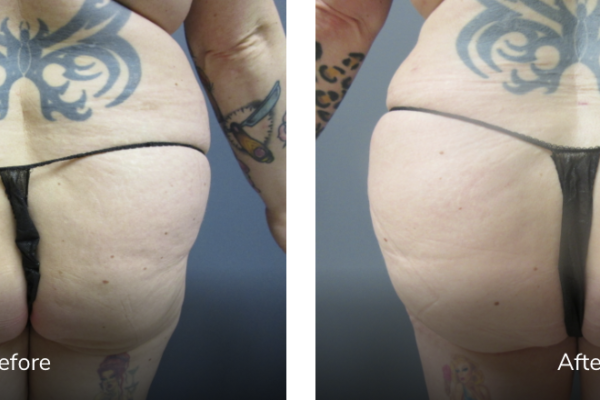 43 yr old female 5'2 180 lbs before and 8 weeks After BBL (fat transfer to buttocks) featured image
