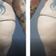43 yr old female 5'2 180 lbs before and 8 weeks After BBL (fat transfer to buttocks) featured image
