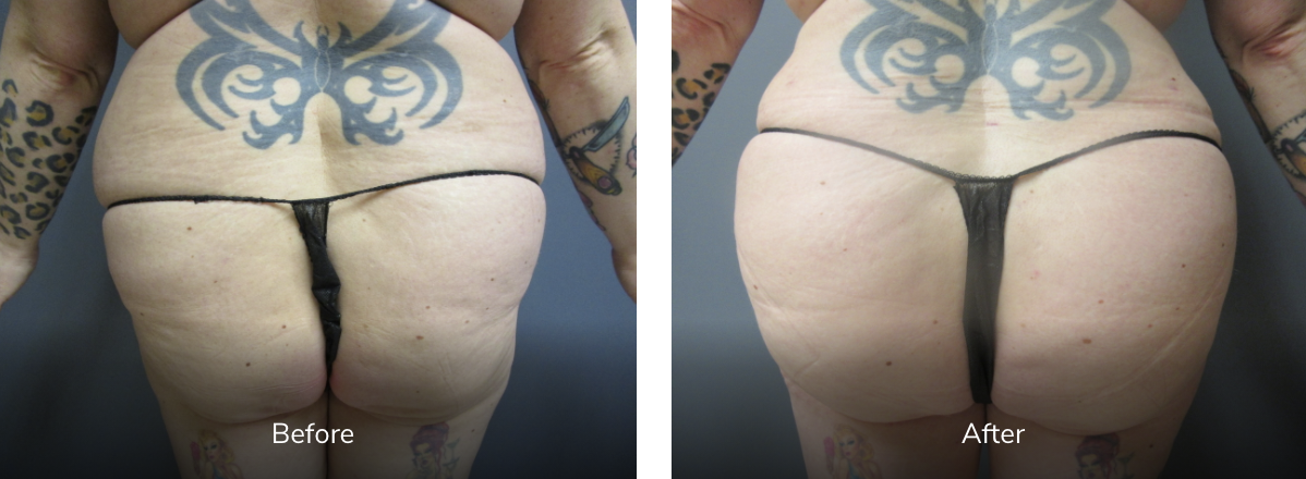 43 yr old female 5'2 180 lbs before and 8 weeks After BBL (fat transfer to buttocks) featured image