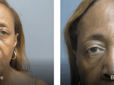 brow lift before and after