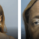 brow lift before and after