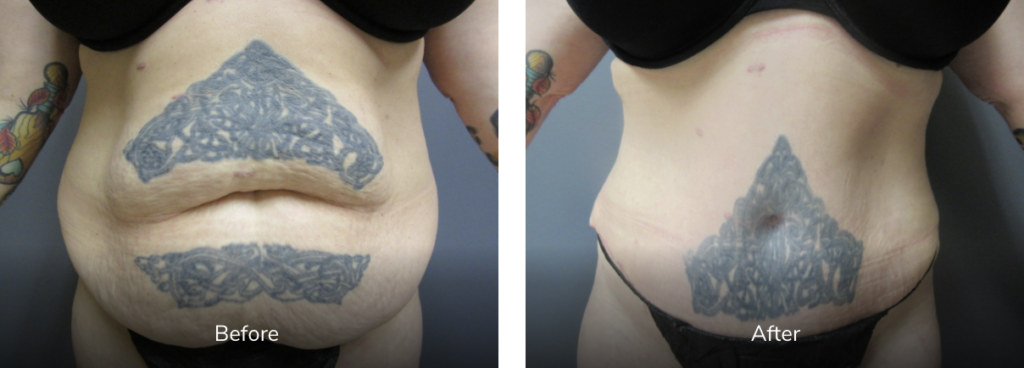 43 year old female before and after after tummy tuck (abdominoplasty) 6 months - featured image