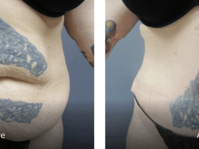 43 year old female before and after after tummy tuck (abdominoplasty) 6 months - featured image