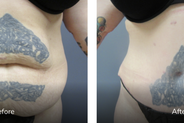 43 year old female before and after after tummy tuck (abdominoplasty) 6 months - featured image