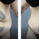 43 year old female before and after after tummy tuck (abdominoplasty) 6 months - featured image