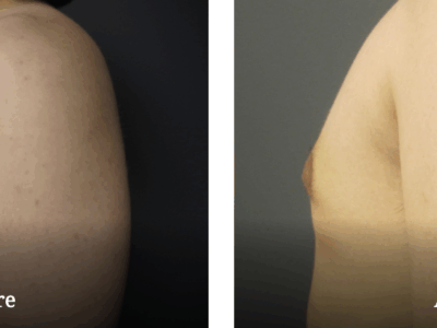 gynecomastia before and after