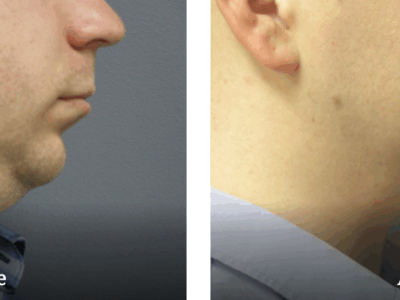 chin liposuction
