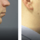 chin liposuction