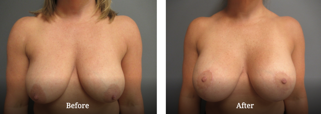 Before and after breast life gallery