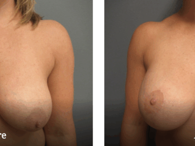 Before and after breast lift gallery