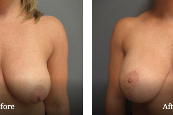 Before and after breast life gallery