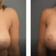 Before and after breast lift gallery