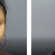 eylid before and after