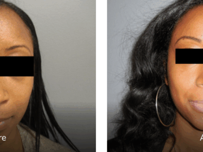 before and after rhinoplasty