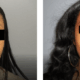 before and after rhinoplasty