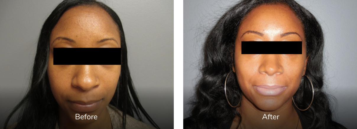 before and after rhinoplasty