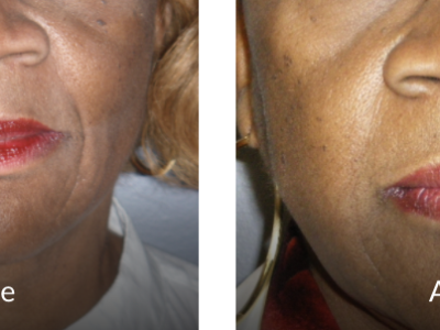 before and after 68 yr old female 1 yr before and after Bellafill (naso-labial fold)