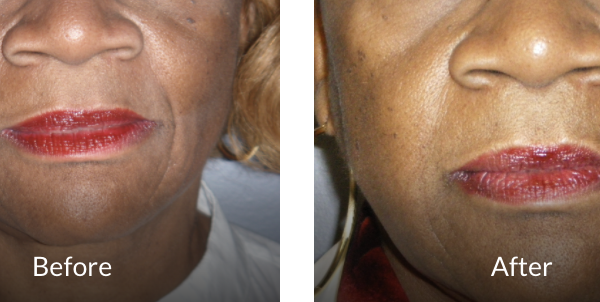 before and after 68 yr old female 1 yr before and after Bellafill (naso-labial fold)