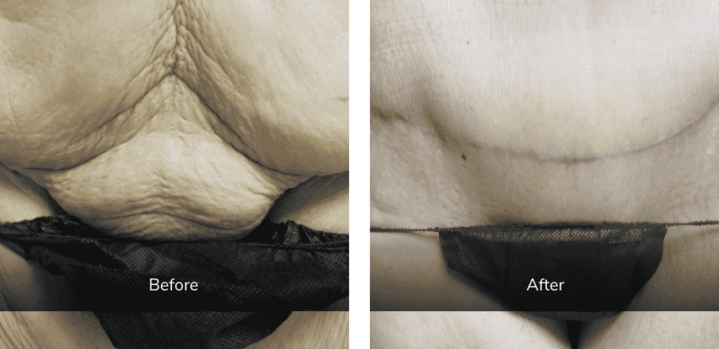 before and after body lift