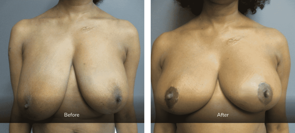 before and after breast reduction