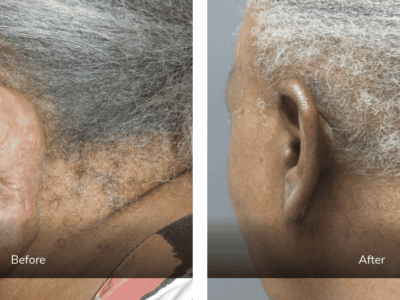ear surgery before and after