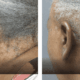 ear surgery before and after