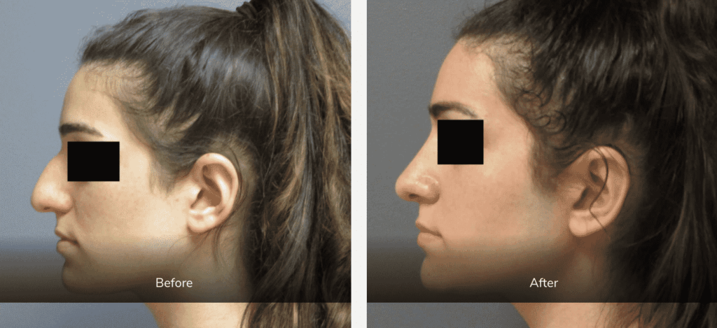 before and after nose surgery
