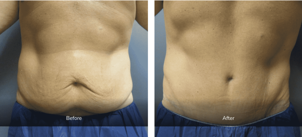 panniculectomy with liposuction before and after