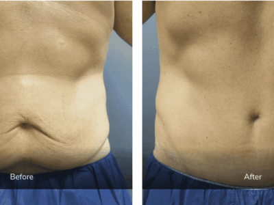 before and after panniculectomy with liposuction