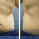 before and after panniculectomy with liposuction