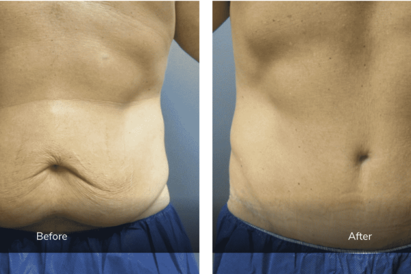 before and after panniculectomy with liposuction