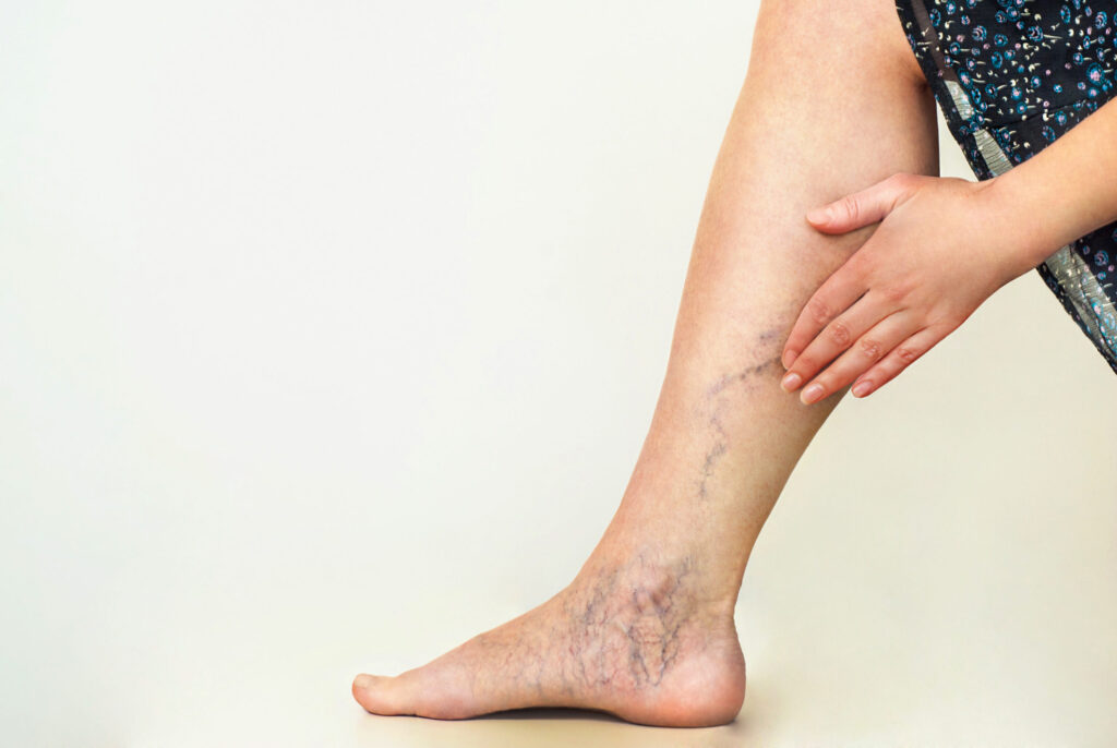 spider veins