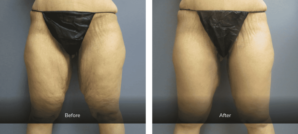 body contouring before and after 
thigh lift 
