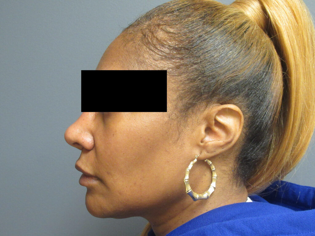 Nose Surgery Aesthetic Plastic Surgery & Laser Center, Michelle