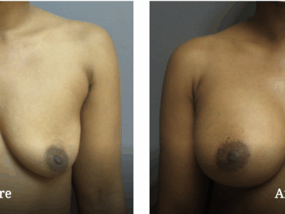 before and after patient