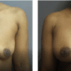 before and after patient