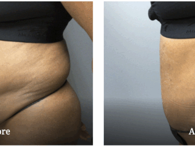 before and after tummy tuck
